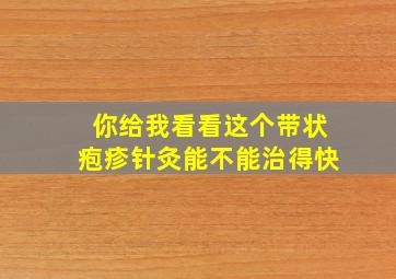 你给我看看这个带状疱疹针灸能不能治得快