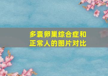 多囊卵巢综合症和正常人的图片对比