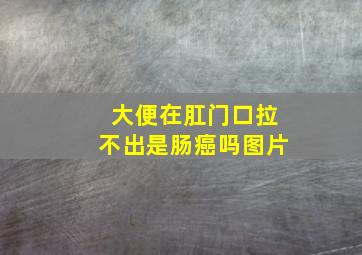 大便在肛门口拉不出是肠癌吗图片