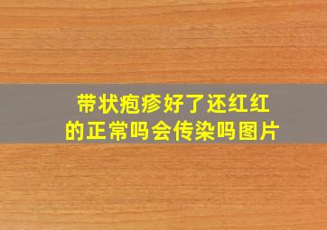 带状疱疹好了还红红的正常吗会传染吗图片