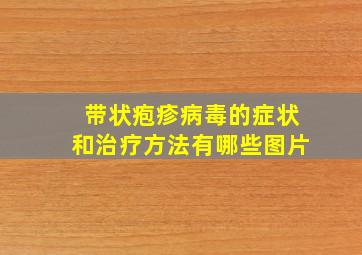 带状疱疹病毒的症状和治疗方法有哪些图片