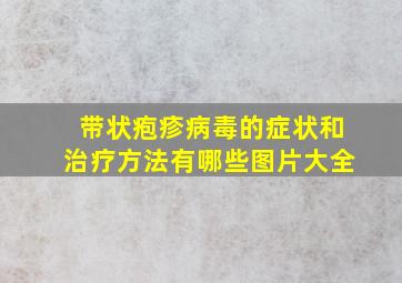 带状疱疹病毒的症状和治疗方法有哪些图片大全