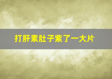 打肝素肚子紫了一大片