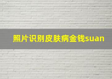 照片识别皮肤病金钱suan