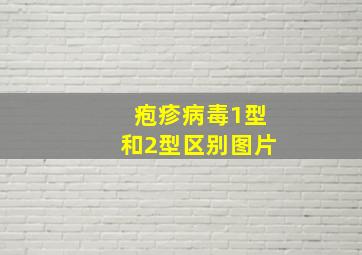 疱疹病毒1型和2型区别图片