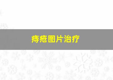 痔疮图片治疗